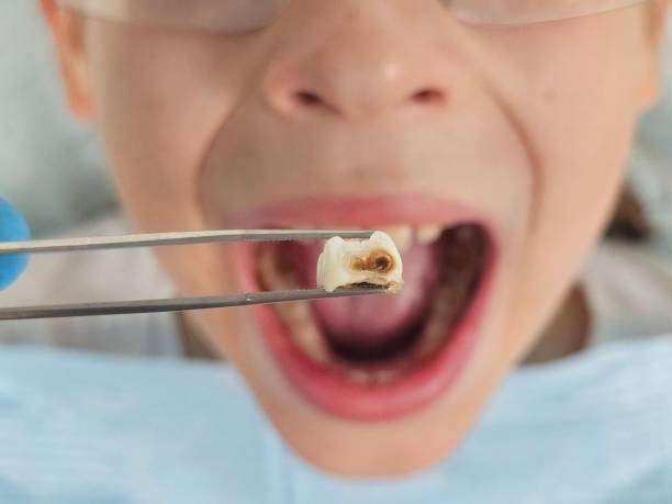 Best Emergency Dental Filling Replacement  in Lumbine, CO